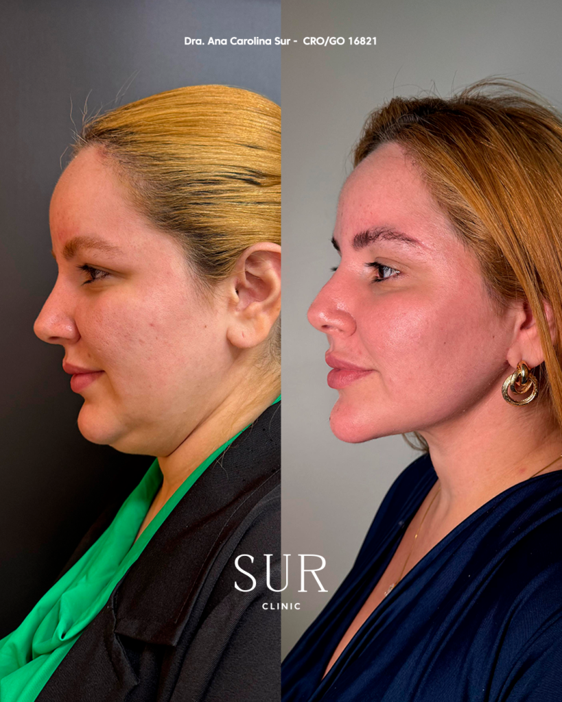 Transformação com o Método Sur