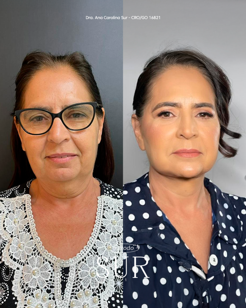 Transformação com o Método Sur