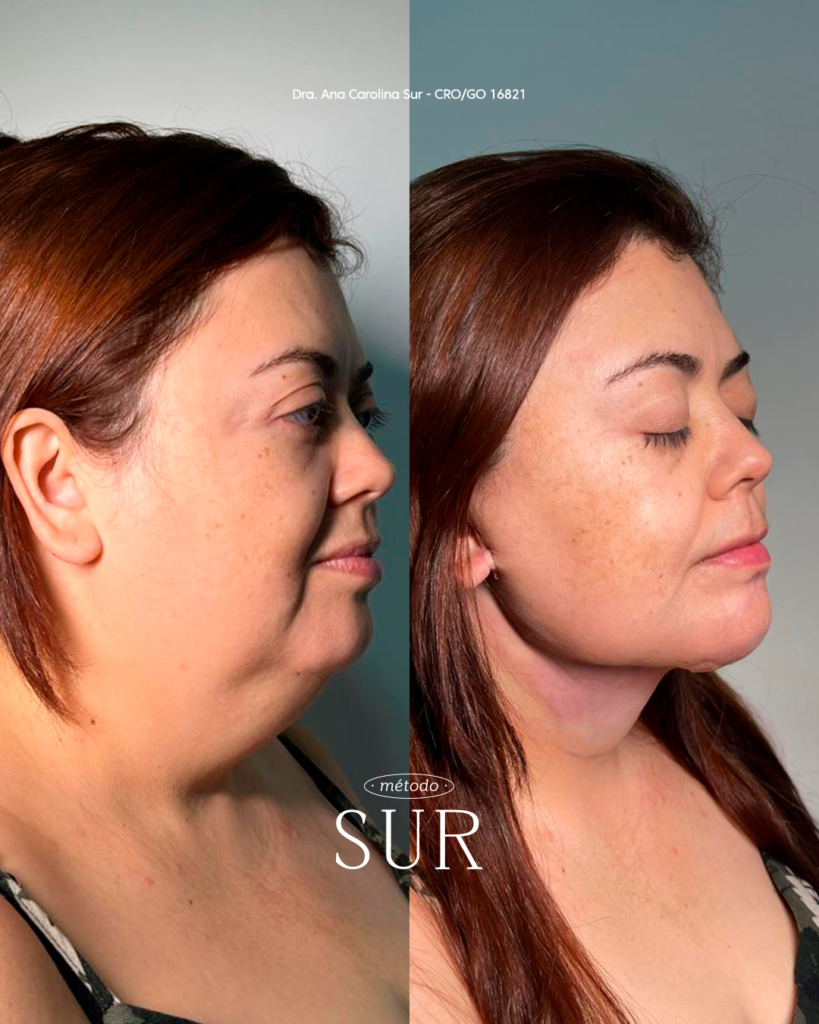 Transformação com o Método Sur