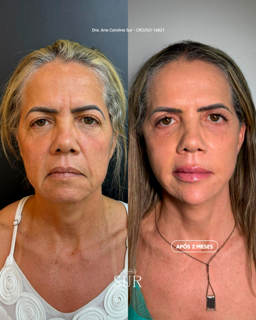 Transformação com o Método Sur